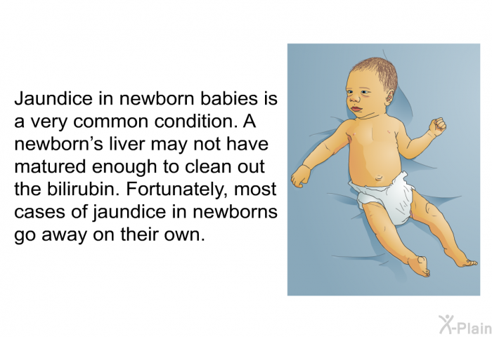 Jaundice in newborn babies is a very common condition. A newborn's liver may not have matured enough to clean out the bilirubin. Fortunately, most cases of jaundice in newborns go away on their own.