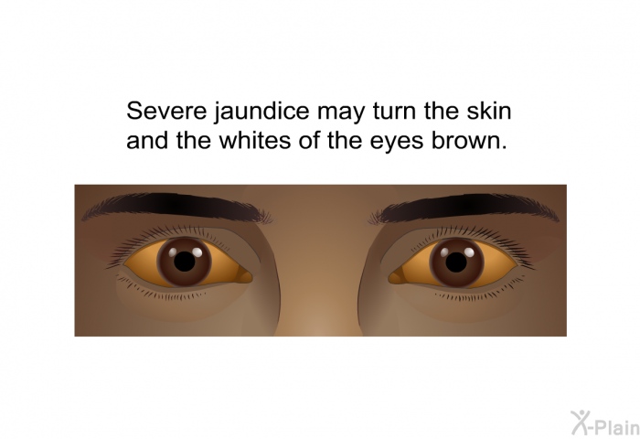Severe jaundice may turn the skin and the whites of the eyes brown.