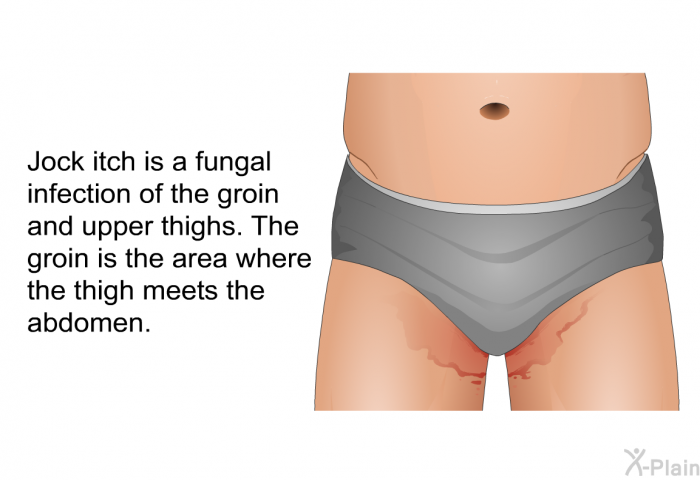 Jock itch is a fungal infection of the groin and upper thighs. The groin is the area where the thigh meets the abdomen.