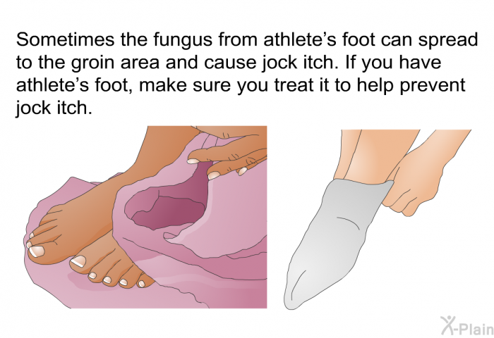 Sometimes the fungus from athlete's foot can spread to the groin area and cause jock itch. If you have athlete's foot, make sure you treat it to help prevent jock itch.