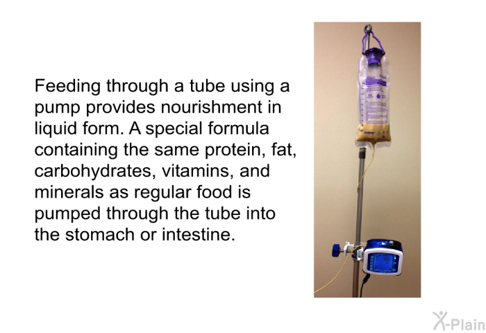 Feeding through a tube using a pump provides nourishment in liquid form. A special formula containing the same protein, fat, carbohydrates, vitamins, and minerals as regular food is pumped through the tube into the stomach or intestine.