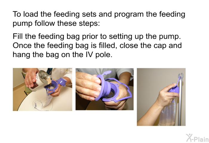 To load the feeding sets and program the feeding pump follow these steps: Fill the feeding bag prior to setting up the pump. Once the feeding bag is filled, close the cap and hang the bag on the IV pole.