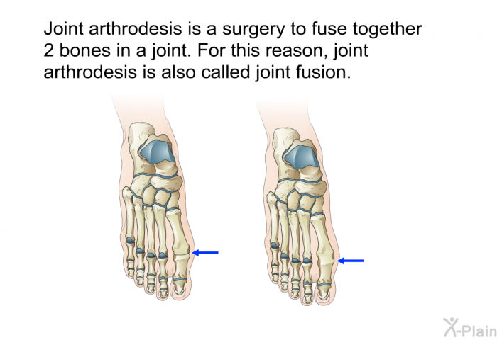 Joint arthrodesis is a surgery to fuse together 2 bones in a joint. For this reason, joint arthrodesis is also called joint fusion.