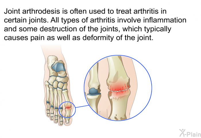 Joint arthrodesis is often used to treat arthritis in certain joints. All types of arthritis involve inflammation and some destruction of the joints, which typically causes pain as well as deformity of the joint.