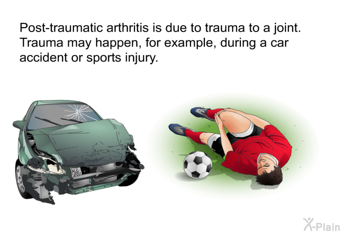 Post-traumatic arthritis is due to trauma to a joint. Trauma may happen, for example, during a car accident or sports injury.