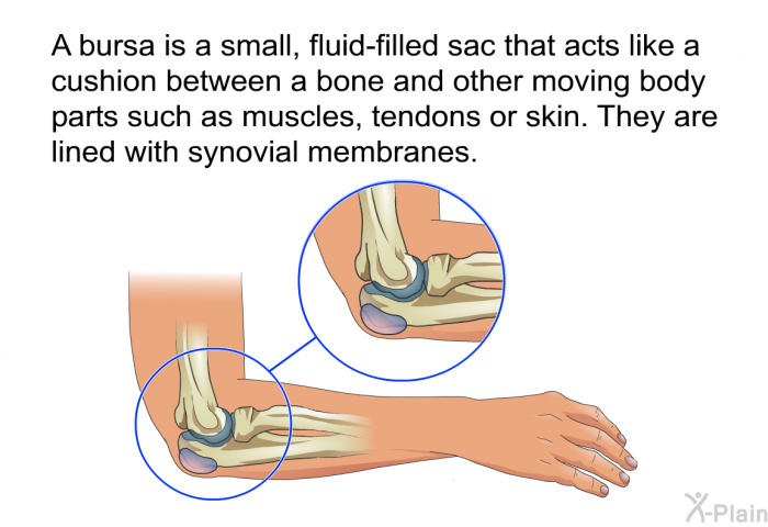 A bursa is a small, fluid-filled sac that acts like a cushion between a bone and other moving body parts such as muscles, tendons or skin. They are lined with synovial membranes.