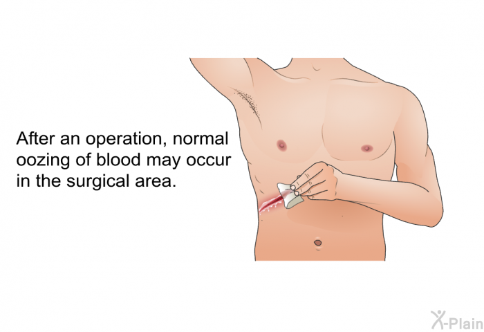 After an operation, normal oozing of blood may occur in the surgical area.