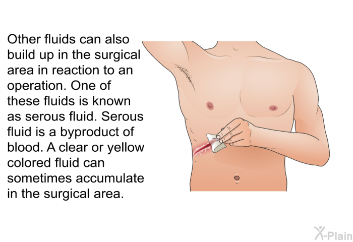 Other fluids can also build up in the surgical area in reaction to an operation. One of these fluids is known as serous fluid. Serous fluid is a byproduct of blood. A clear or yellow colored fluid can sometimes accumulate in the surgical area.