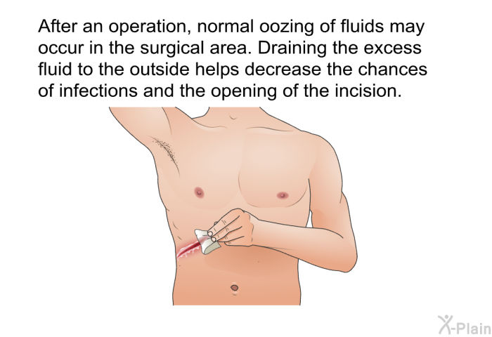 After an operation, normal oozing of fluids may occur in the surgical area. Draining the excess fluid to the outside helps decrease the chances of infections and the opening of the incision.