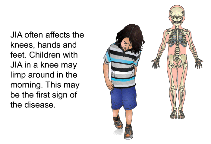 JIA often affects the knees, hands and feet. Children with JIA in a knee may limp around in the morning. This may be the first sign of the disease.