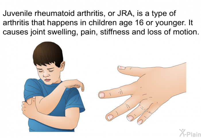 Juvenile rheumatoid arthritis, or JRA, is a type of arthritis that happens in children age 16 or younger. It causes joint swelling, pain, stiffness and loss of motion.