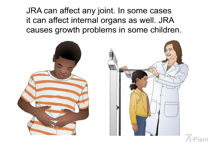 JRA can affect any joint. In some cases it can affect internal organs as well. JRA causes growth problems in some children.