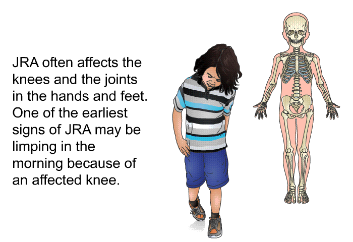 JRA often affects the knees and the joints in the hands and feet. One of the earliest signs of JRA may be limping in the morning because of an affected knee.