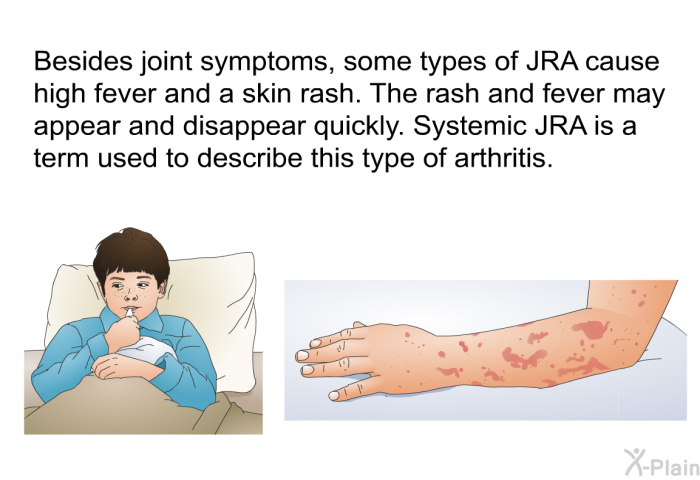Besides joint symptoms, some types of JRA cause high fever and a skin rash. The rash and fever may appear and disappear quickly. Systemic JRA is a term used to describe this type of arthritis.