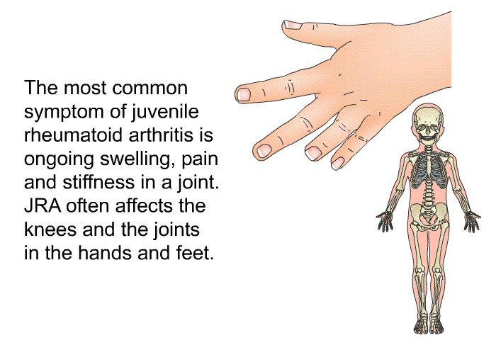 The most common symptom of juvenile rheumatoid arthritis is ongoing swelling, pain and stiffness in a joint. JRA often affects the knees and the joints in the hands and feet.