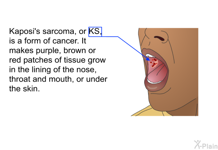 Kaposi's sarcoma, or KS, is a form of cancer. It makes purple, brown or red patches of tissue grow in the lining of the nose, throat and mouth, or under the skin.