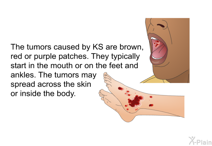The tumors caused by KS are brown, red or purple patches. They typically start in the mouth or on the feet and ankles. The tumors may spread across the skin or inside the body.