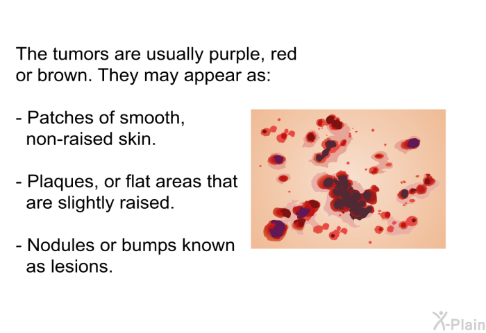 The tumors are usually purple, red or brown. They may appear as:  Patches of smooth, non-raised skin. Plaques, or flat areas that are slightly raised. Nodules or bumps known as lesions.