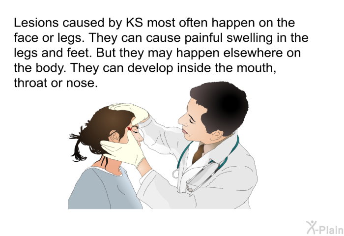 Lesions caused by KS most often happen on the face or legs. They can cause painful swelling in the legs and feet. But they may happen elsewhere on the body. They can develop inside the mouth, throat or nose.