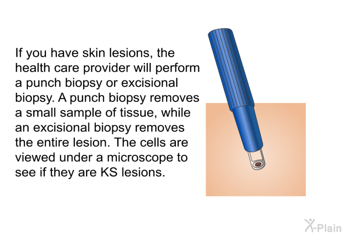 If you have skin lesions, the health care provider will perform a punch biopsy or excisional biopsy. A punch biopsy removes a small sample of tissue, while an excisional biopsy removes the entire lesion. The cells are viewed under a microscope to see if they are KS lesions.