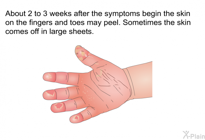 About 2 to 3 weeks after the symptoms begin the skin on the fingers and toes may peel. Sometimes the skin comes off in large sheets.