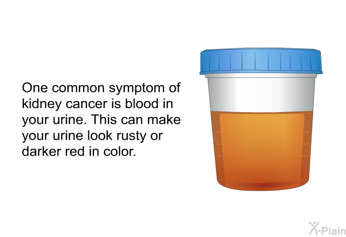 One common symptom of kidney cancer is blood in your urine. This can make your urine look rusty or darker red in color.