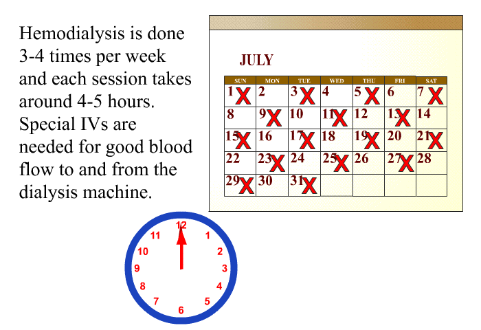 Hemodialysis is done 3-4 times per week and each session takes around 4-5 hours. Special IVs are needed for good blood flow to and from the dialysis machine.