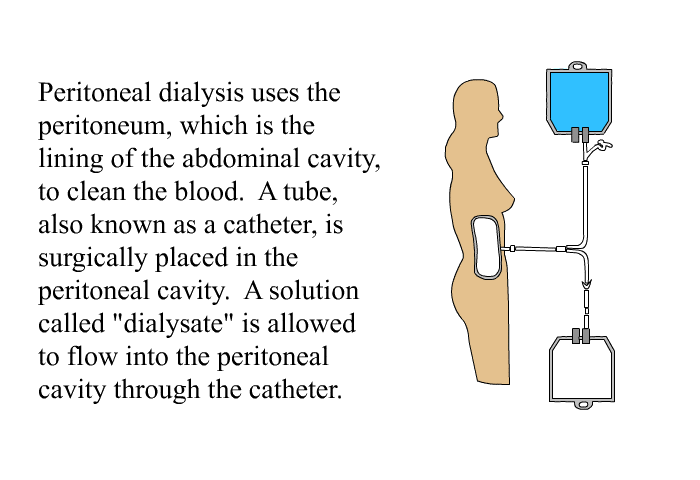 Peritoneal dialysis uses the peritoneum, which is the lining of the abdominal cavity, to clean the blood. A tube, also known as a catheter, is surgically placed in the peritoneal cavity. A solution called “dialysate” is allowed to flow into the peritoneal cavity through the catheter.