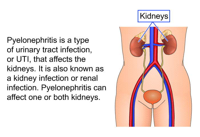 Pyelonephritis is a type of urinary tract infection, or UTI, that affects the kidneys. It is also known as a kidney infection or renal infection. Pyelonephritis can affect one or both kidneys.