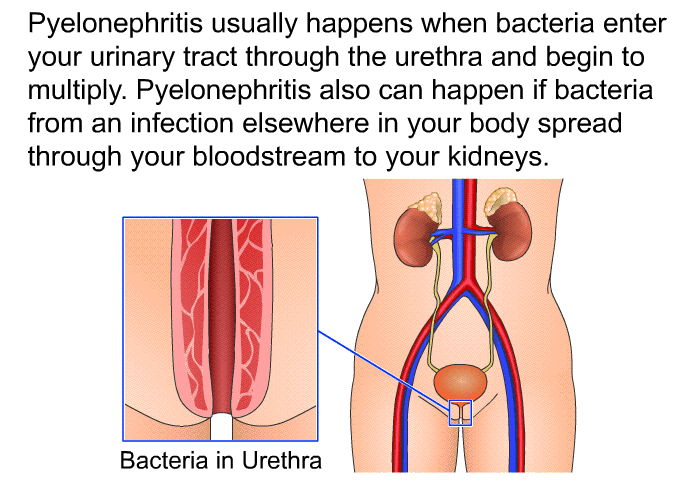Pyelonephritis usually happens when bacteria enter your urinary tract through the urethra and begin to multiply. Pyelonephritis also can happen if bacteria from an infection elsewhere in your body spread through your bloodstream to your kidneys.