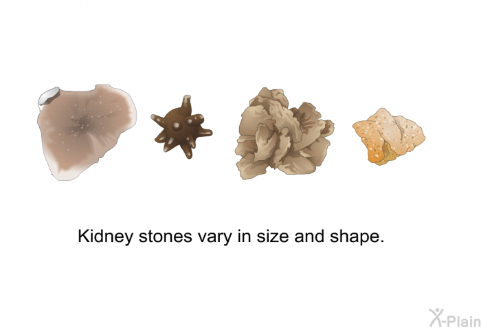 Kidney stones vary in size and shape.