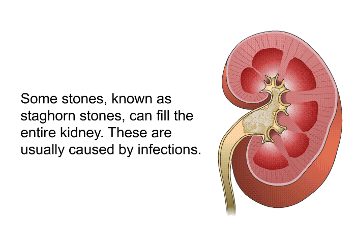 Some stones, known as staghorn stones, can fill the entire kidney. These are usually caused by infections.