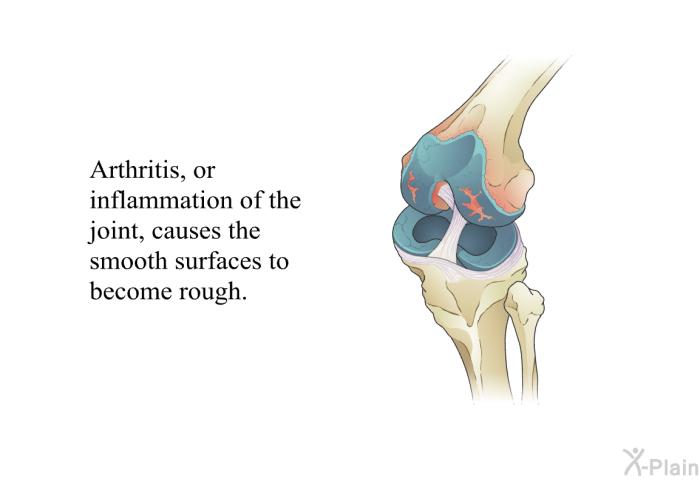 Arthritis, or inflammation of the joint, causes the smooth surfaces to become rough.