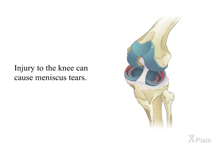 Injury to the knee can cause meniscus tears.