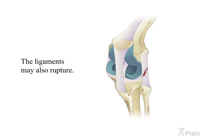 The ligaments may also rupture.