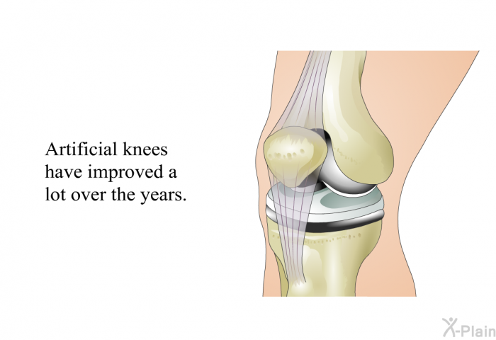 Artificial knees have improved a lot over the years.