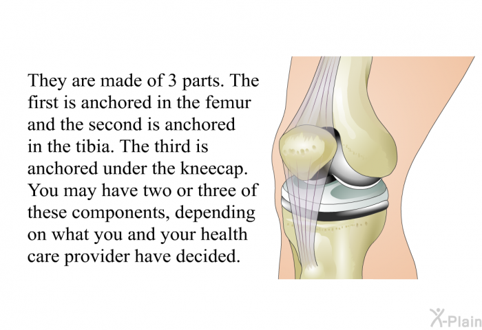 They are made of 3 parts. The first is anchored in the femur and the second is anchored in the tibia. The third is anchored under the kneecap. You may have two or three of these components, depending on what you and your health care provider have decided.