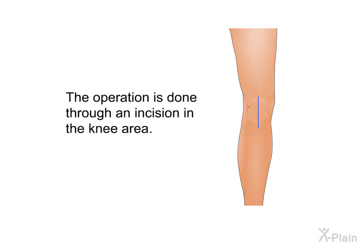 The operation is done through an incision in the knee area.