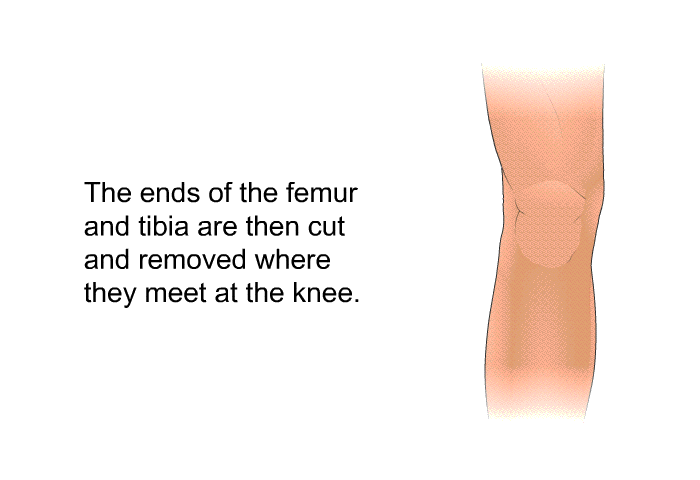 The ends of the femur and tibia are then cut and removed where they meet at the knee.