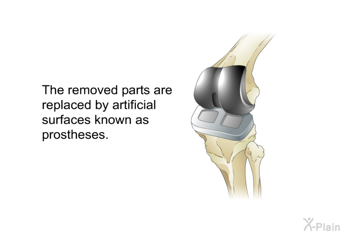 The removed parts are replaced by artificial surfaces known as prostheses.