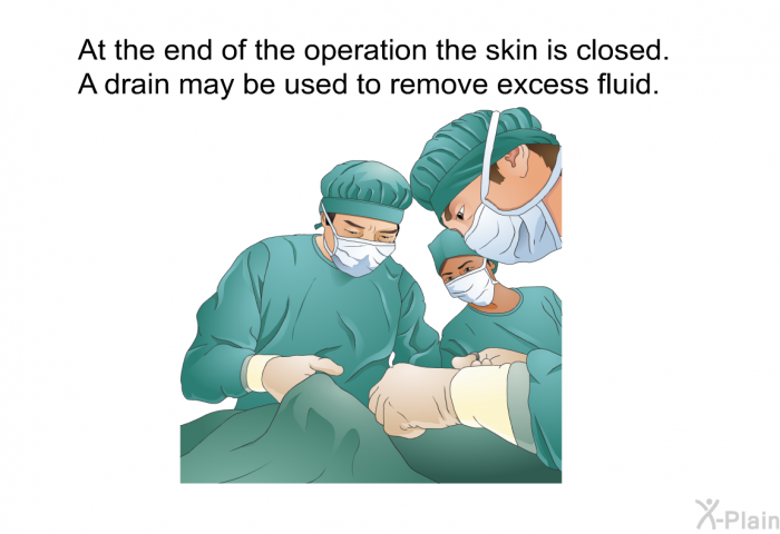 At the end of the operation the skin is closed. A drain may be used to remove excess fluid.