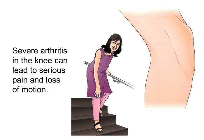 Severe arthritis in the knee can lead to serious pain and loss of motion.