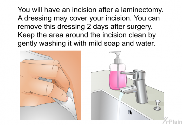 You will have an incision after a laminectomy. A dressing may cover your incision. You can remove this dressing 2 days after surgery. Keep the area around the incision clean by gently washing it with mild soap and water.