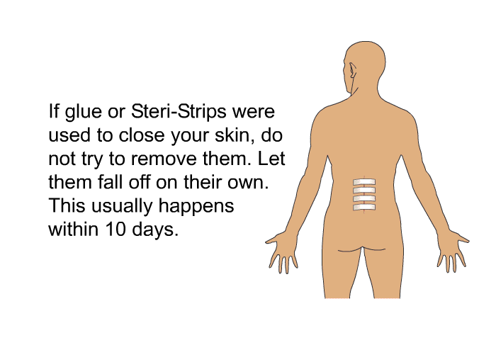 If glue or Steri-Strips were used to close your skin, do not try to remove them. Let them fall off on their own. This usually happens within 10 days.