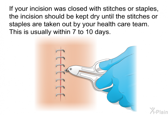 If your incision was closed with stitches or staples, the incision should be kept dry until the stitches or staples are taken out by your health care team. This is usually within 7 to 10 days.