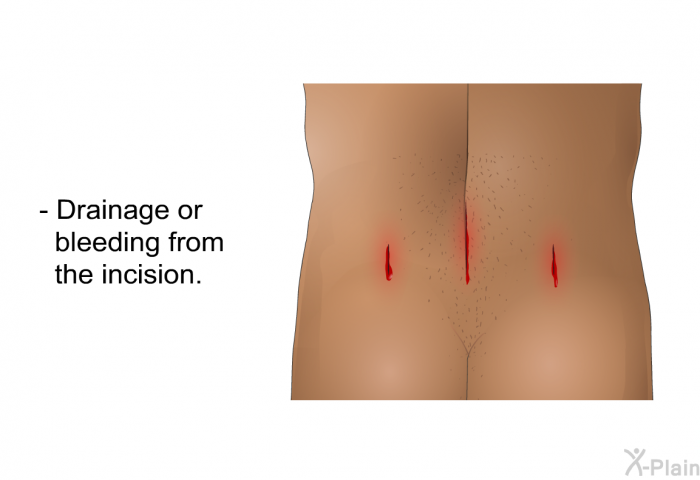 Drainage or bleeding from the incision.