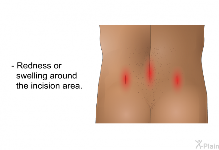 Redness or swelling around the incision area.