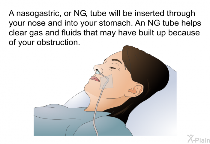 A nasogastric, or NG, tube will be inserted through your nose and into your stomach. An NG tube helps clear gas and fluids that may have built up because of your obstruction.