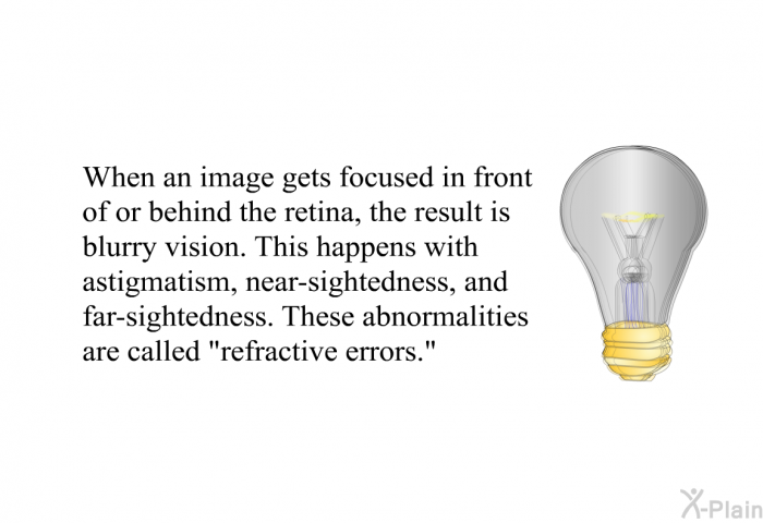 When an image gets focused in front of or behind the retina, the result is blurry vision. This happens with astigmatism, near-sightedness, and far-sightedness. These abnormalities are called "refractive errors."