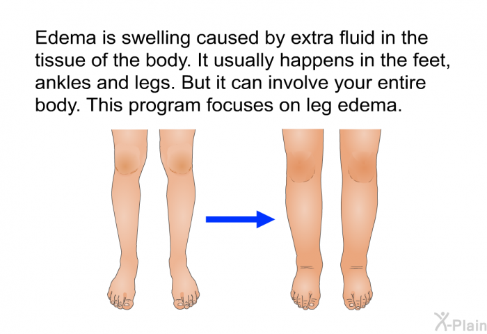 Edema is swelling caused by extra fluid in the tissue of the body. It usually happens in the feet, ankles and legs. But it can involve your entire body. This program focuses on leg edema.